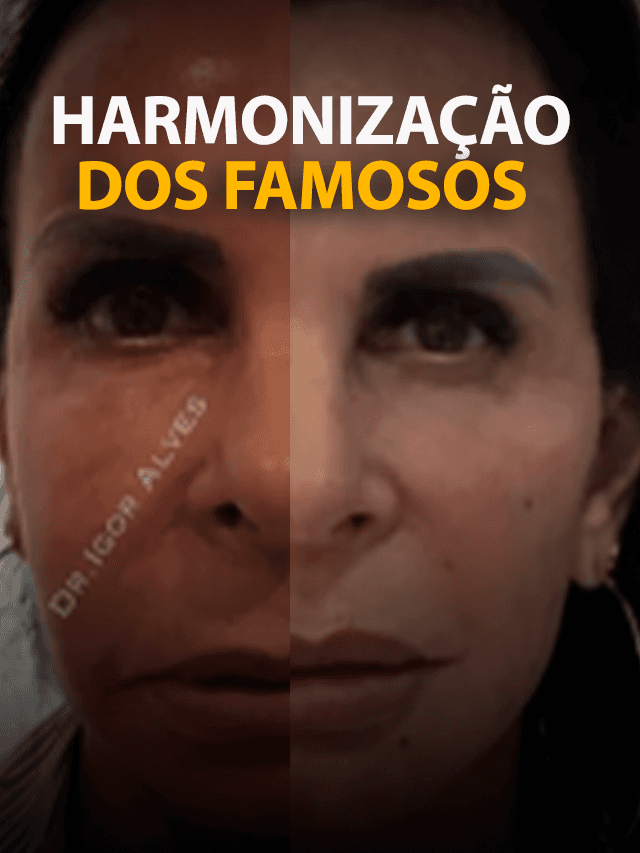 Harmonização facial do Famosos