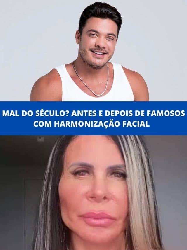 Mal do século? Antes e depois de famosos com harmonização facial