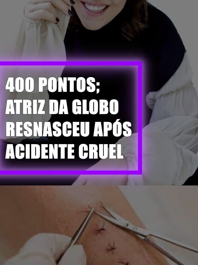 400 PONTOS, Atriz da Globo renasceu após acidente cruel
