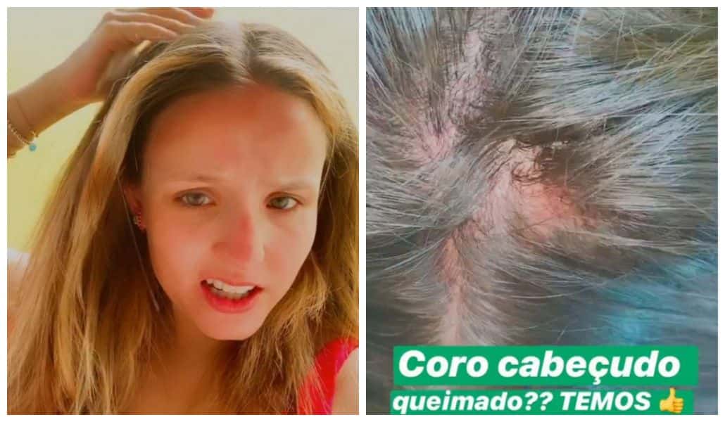 Larissa Manoela queimou o coro cabeludo após dia de sol e teve que passar o dia 31 se cuidando e evitando piorar a situação. A atriz contou o que aprontou nas redes sociais (Foto: Reprodução/ Instagram)