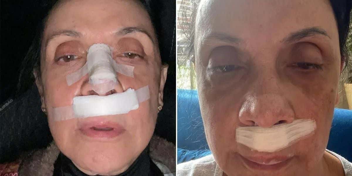 Cininha de Paula após acidente (Reprodução - Globo)