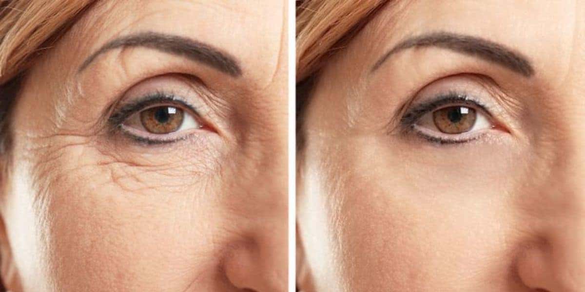 Harmonização facial caseira para tirar rugas (Reprodução: Internet)