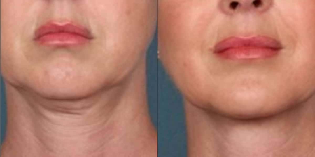 Rosto com Papada antes e depois de exercícios (Foto: Divulgação)