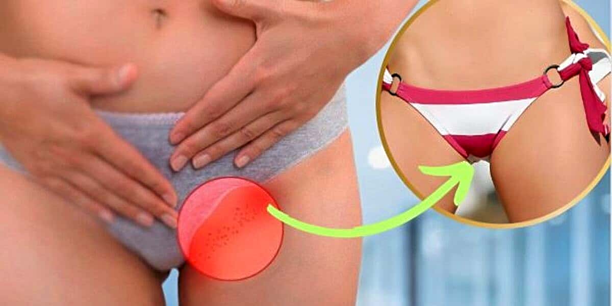Se livre dos pelos encravados e bolinhas vermelhas causadas pela depilação (Foto Reprodução/Montagem/Lennita/TV Foco)