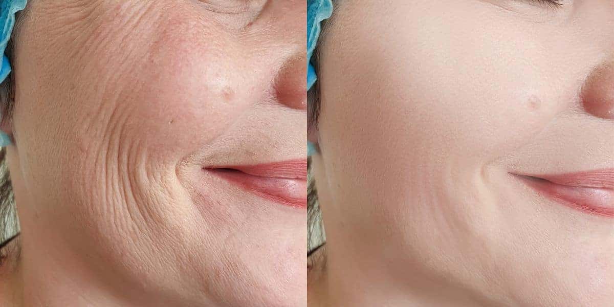 Peeling natural remove oleosidade, rugas e manchas (Reprodução: Montagem TV Foco)
