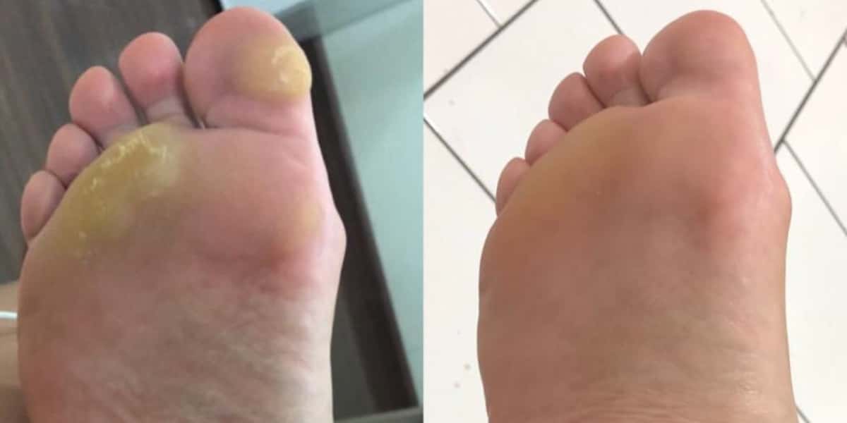 Calos nos pés podem ser resolvidos de forma simples (Foto: Divulgação)