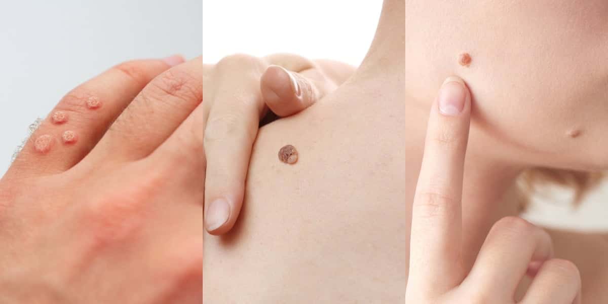 Adeus verruga com essas receitas caseiras (Foto: Divulgação)