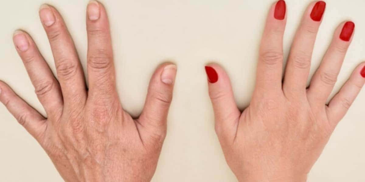 Mistura com 3 ingredientes dá adeus ao ressecamento e aos calos nas mãos (Foto: Reprodução/ Internet)