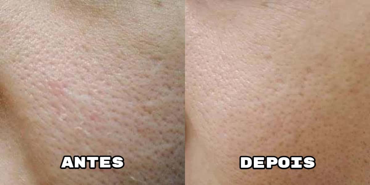 Essa receita ajuda a eliminar poros dilatados (Foto: Montagem)