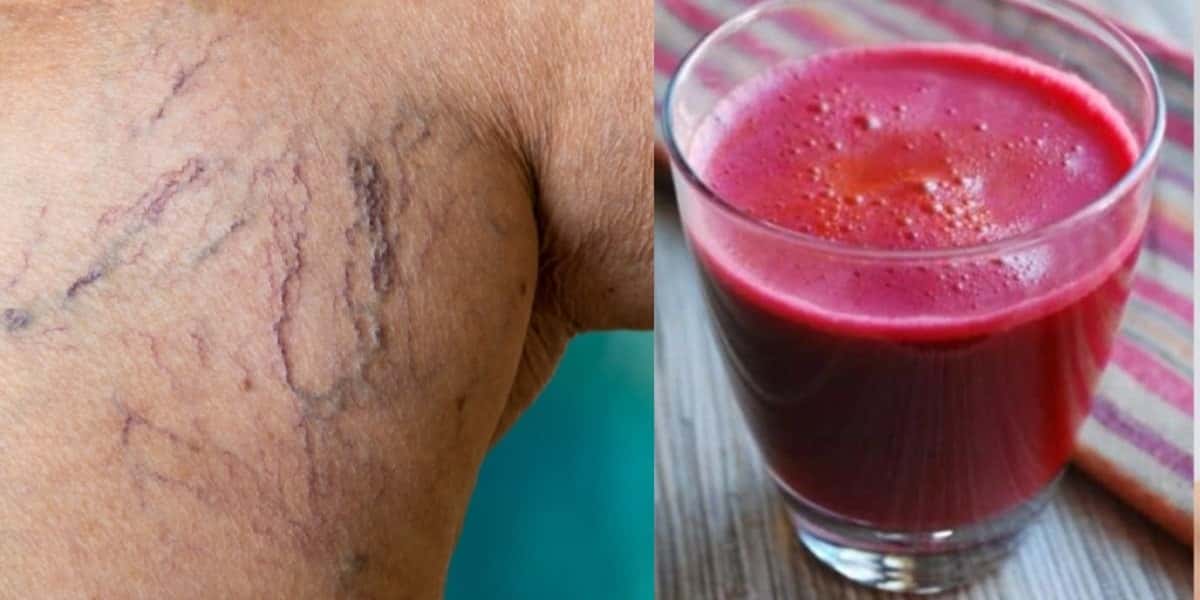 O suco milagroso com único ingrediente popular que suga varizes das 55+ - Foto: Montagem