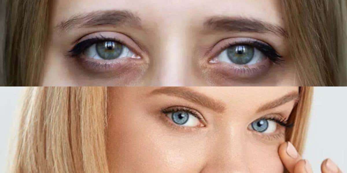 Com olheiras / Sem olheiras - Montagem: TVFOCO
