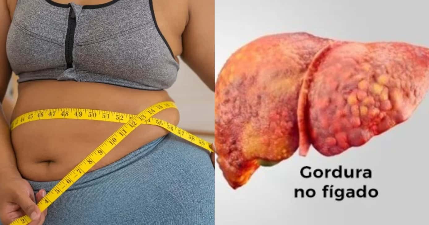 Gordura no fígado (Foto: Divulgação)