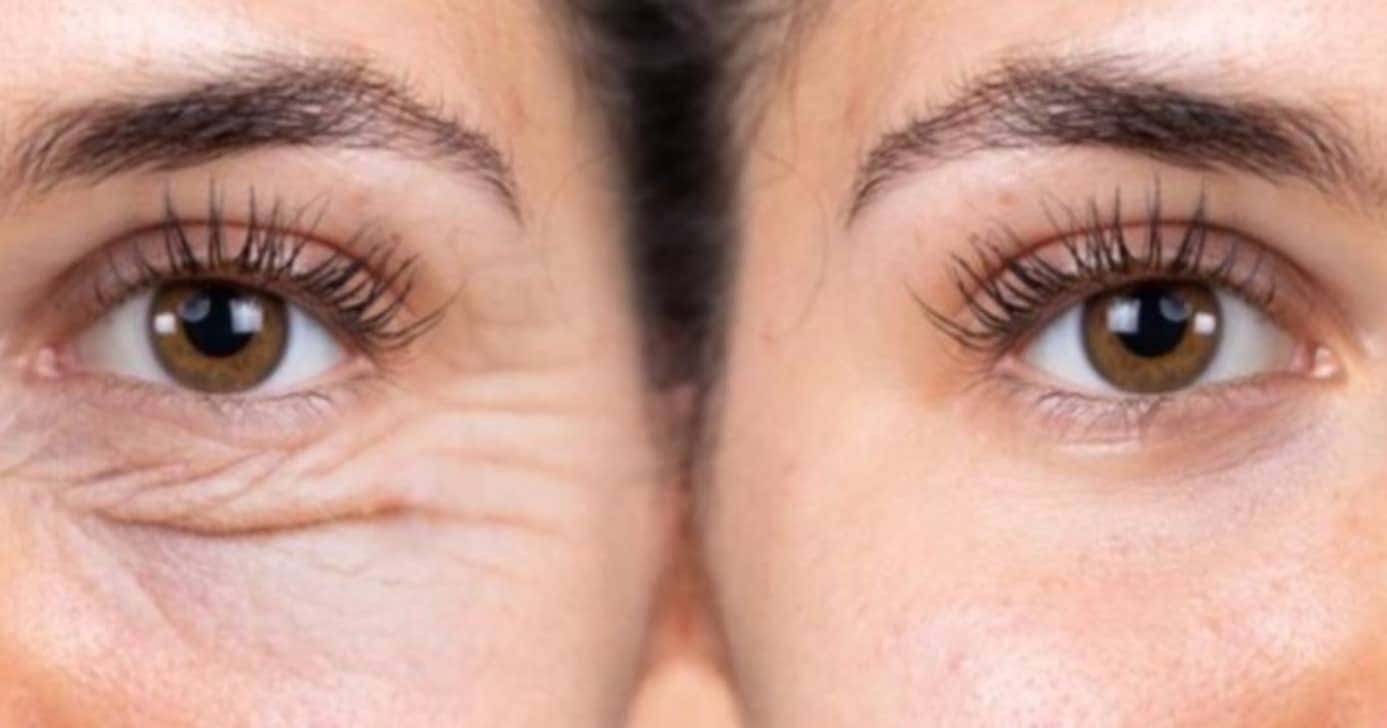 Creme clareia ao redor dos olhos e combate olheiras (Foto: Internet)