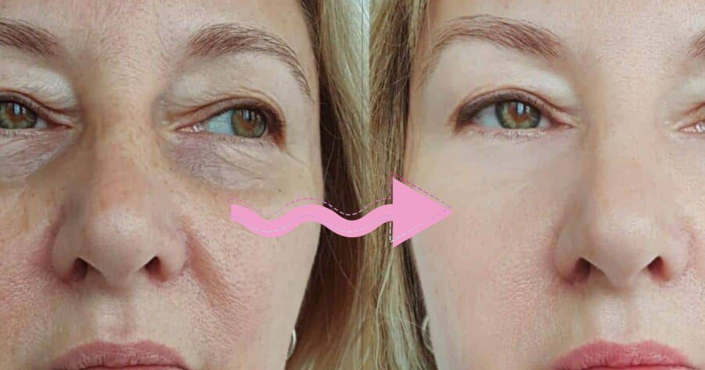 Antes e depois - Montagem: TVFOCO
