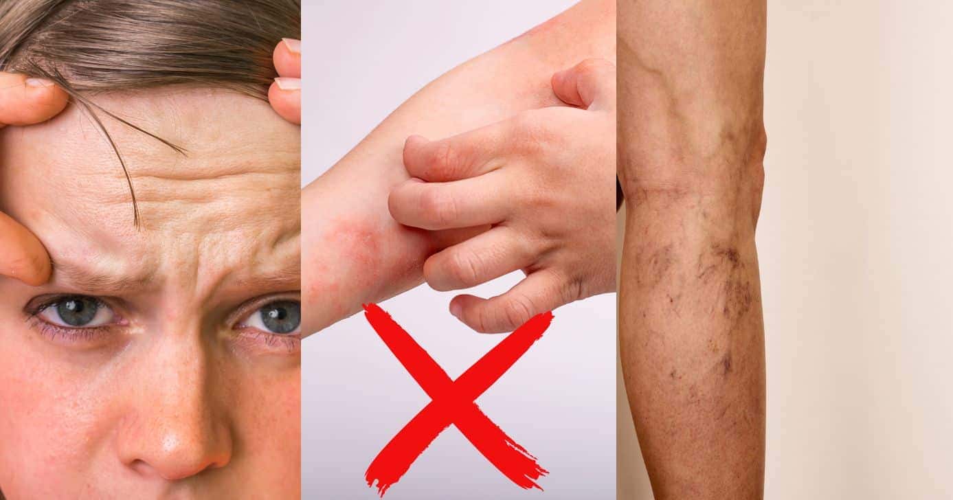 Varizes, Dermatite e Rugas (Reprodução - Internet)