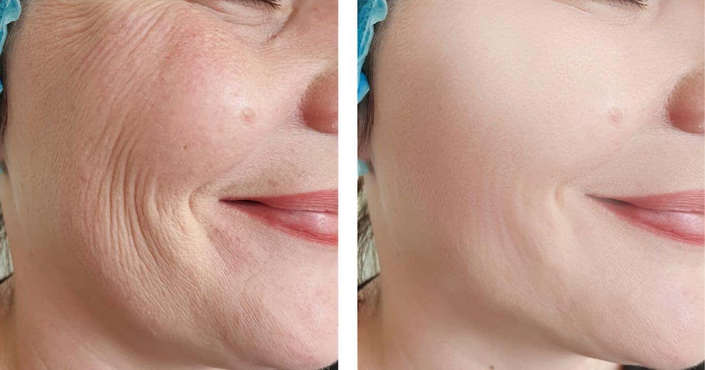 Antes e depois de pele seca e com rugas (Foto: Canva)