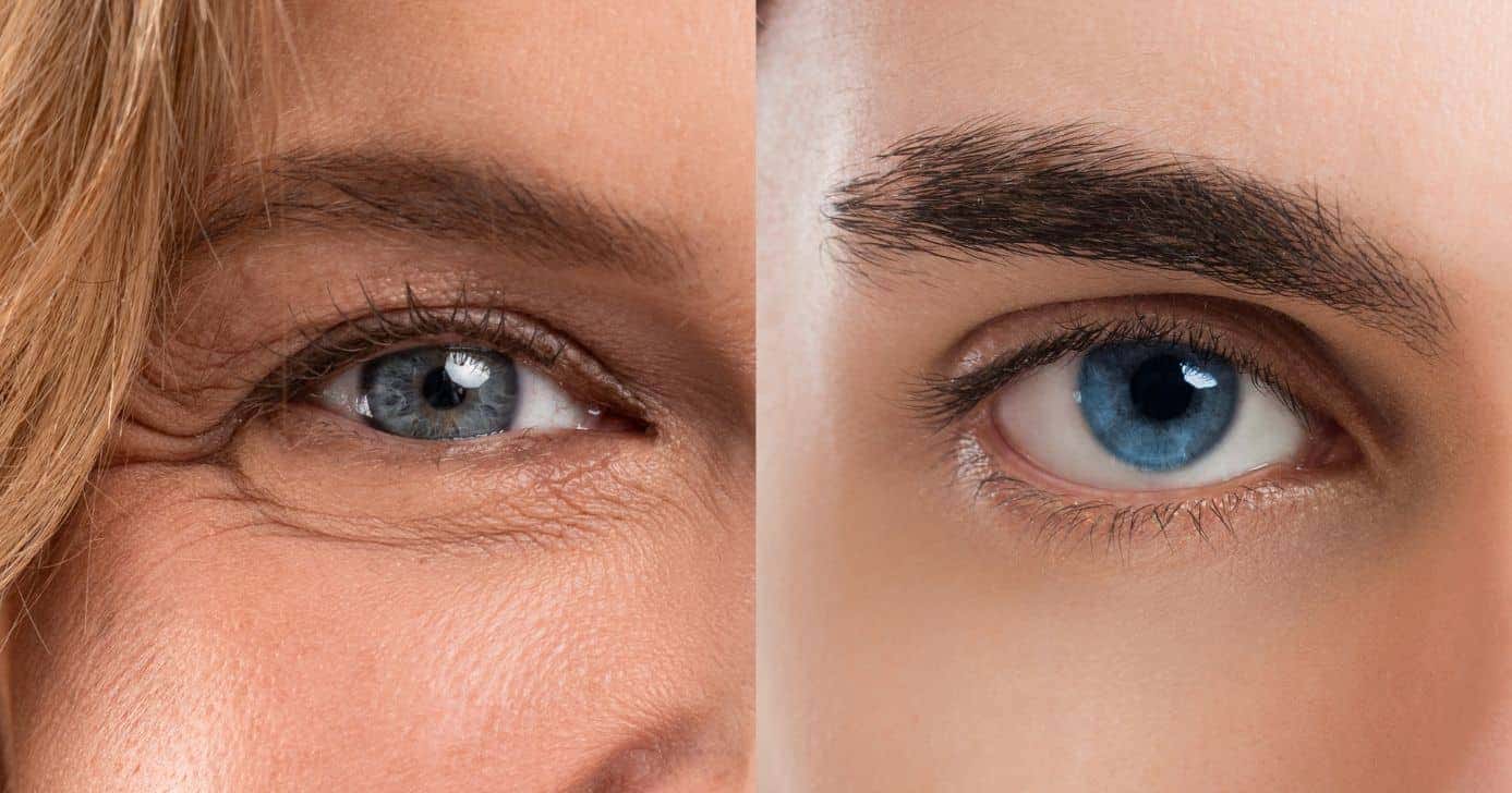 Mulher com linha fina na região dos olhos e sem (Fotos: Canva)