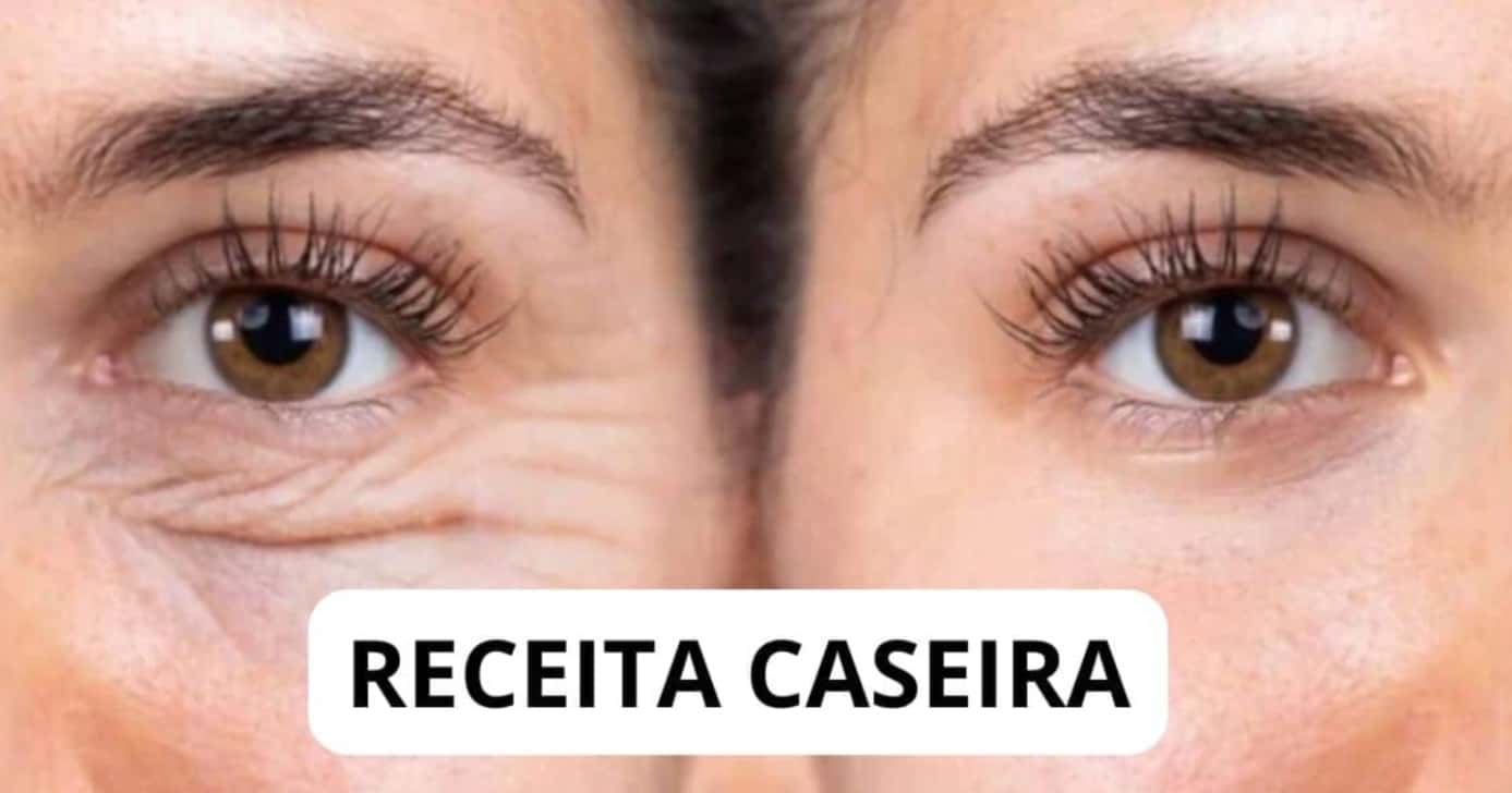 Descobri como dar adeus às rugas sem plástica com esse botox caseiro - Foto: Montagem