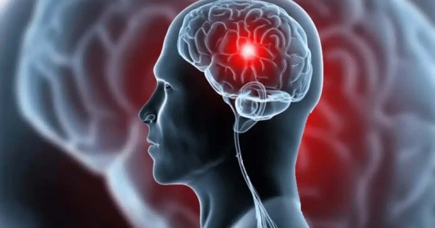 Tontura, dor de cabeça e mais: 5 sinais que antecedem um AVC (Foto: Reprodução/ Internet)