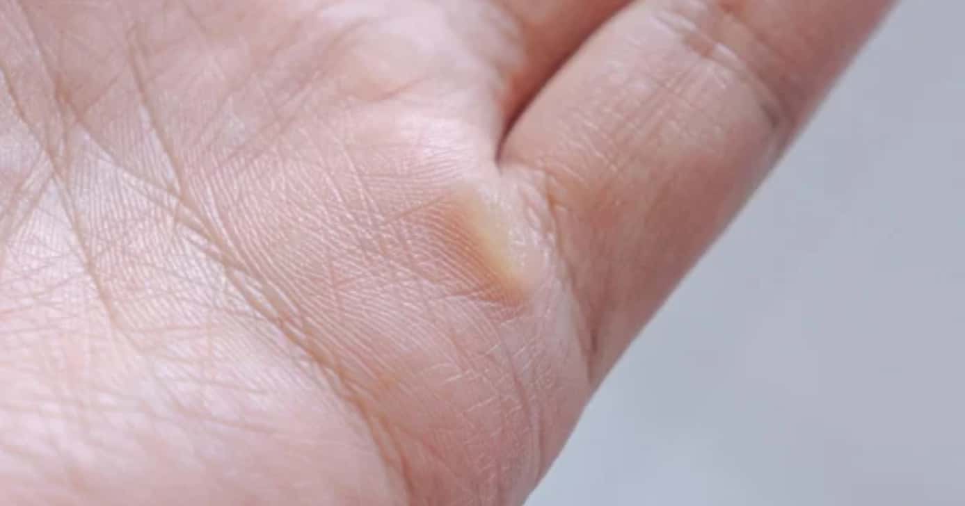 Como eliminar calos das mãos (Foto: Divulgação)