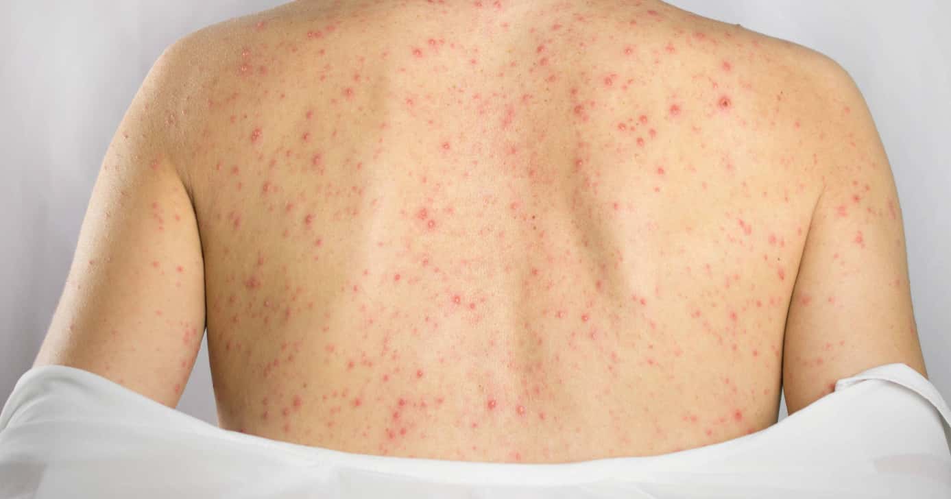 Espinhas nas costas (Foto: Divulgação)