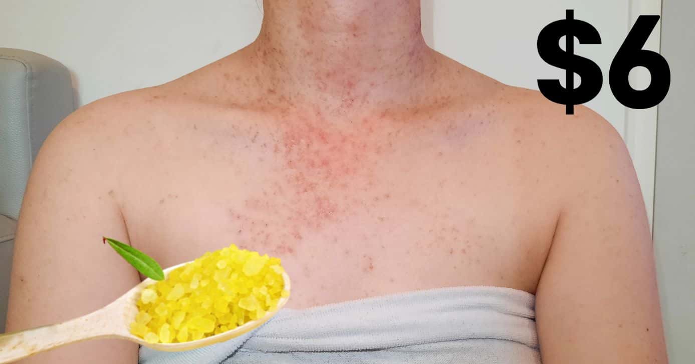 Como fazer receitinha caseira com produto de R$ 6 reais para dar fim a foliculite e clarear áreas escuras (Foto Reprodução/Montagem/TV Foco/Canva/Paola)