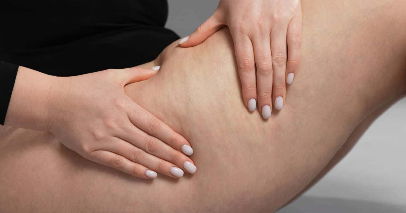 Mulher com celulite (Foto: Canva)