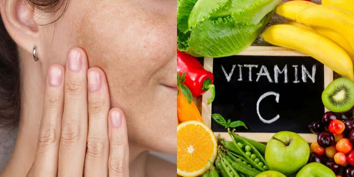 Fim das manchas na pele com cremes com vitamina C (Reprodução: Montagem TV Foco)
