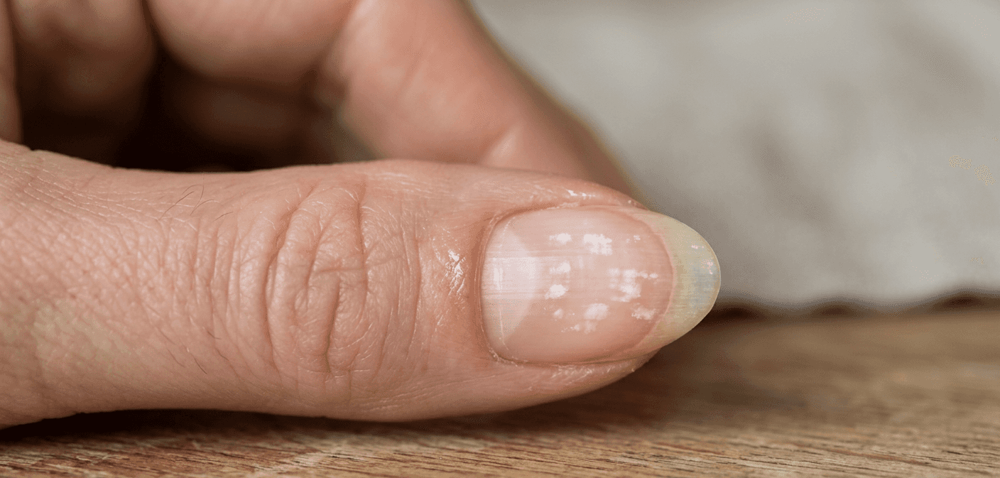 Unhas com manchas brancas (Foto: Montagem TV Foco / GMN)