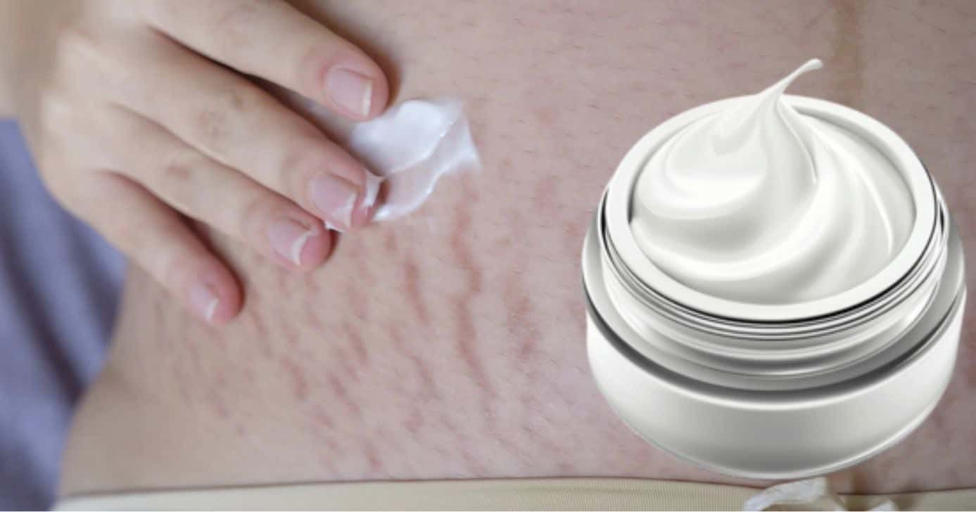 Estrias: Creme de farmácia recupera elasticidade da pele flácida (Foto Reprodução/Montagem/TV Foco/Canva/Paola)