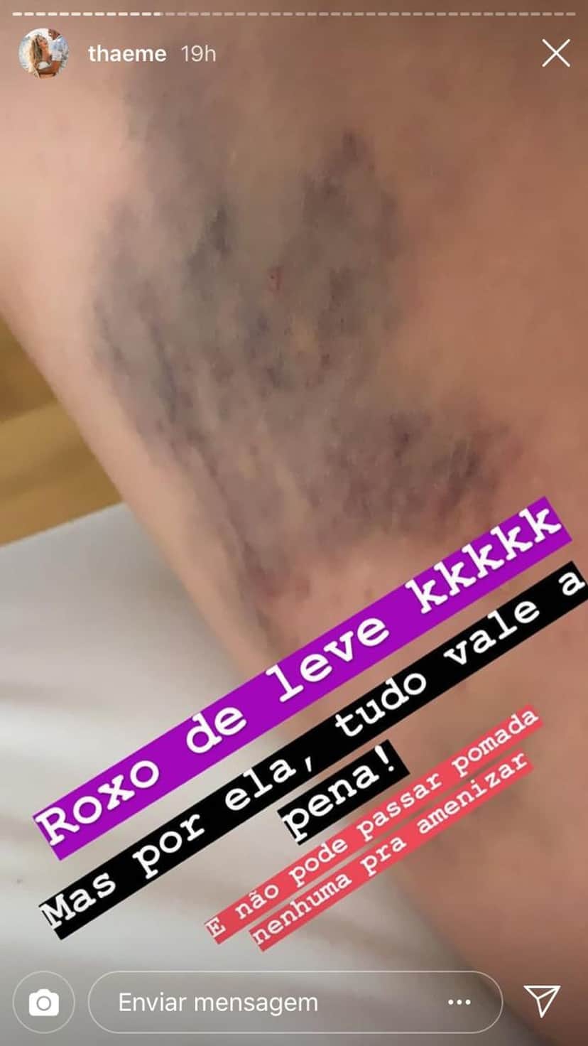 Thaeme mostrou mancha feia no corpo (Foto: Reprodução/Instagram)