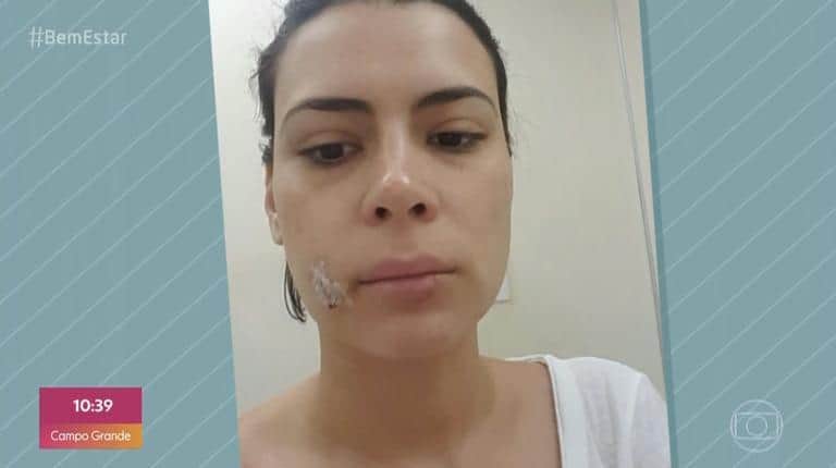 Michelle Loreto mostrou rosto após ataque de sua cadelinha (Foto: Reprodução/TV Globo) Michelle Loreto mostrou rosto após ataque de sua cadelinha (Foto: Reprodução/TV Globo)