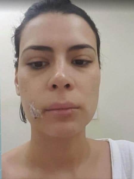 Michelle Loreto, da TV Globo, mostrou pontos no rosto após mordida de cachorro (Reprodução: TV Globo) Michelle Loreto, da TV Globo, mostrou pontos no rosto após mordida de cachorro (Reprodução: TV Globo)