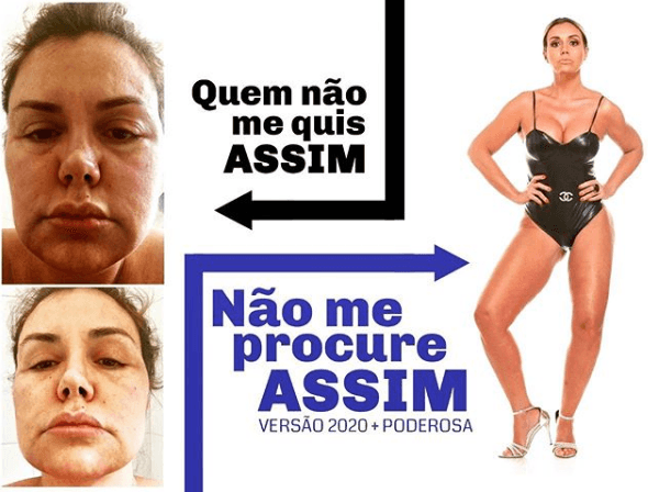 Renata Banhara inchada com infecção de dente (Foto: Reprodução/ Instagram) Renata Banhara inchada com infecção de dente (Foto: Reprodução/ Instagram)