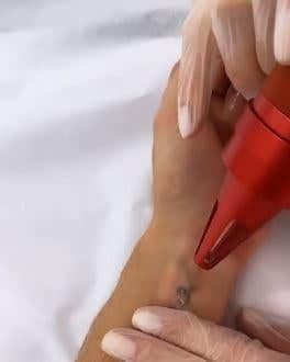 Juju faz remoção de tatuagem (Foto: Reprodução) Juju faz remoção de tatuagem (Foto: Reprodução)