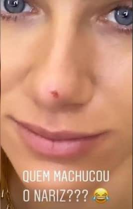 Giovanna Ewbank machucou o nariz e compartilhou fotos com os seus fãs (Foto: Instagram) Giovanna Ewbank machucou o nariz e compartilhou fotos com os seus fãs (Foto: Instagram)