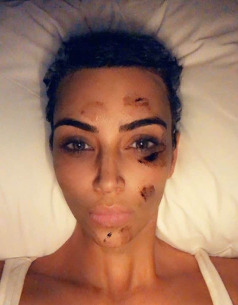 Kim Kardashian sofre de psoríase (Foto: reprodução - Instagram) Kim Kardashian sofre de psoríase (Foto: reprodução - Instagram)