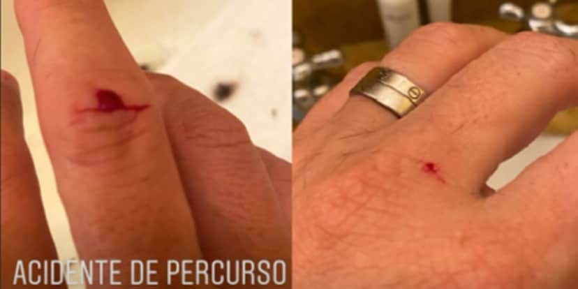 Acidente: Luciano Huck exibindo os machucados em suas mãos (Foto: Montagem) Acidente: Luciano Huck exibindo os machucados em suas mãos (Foto: Montagem)