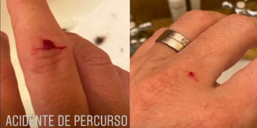 Luciano Huck exibindo os machucados em suas mãos durante corte de cabelo ao lado de Angélica Luciano Huck exibindo os machucados em suas mãos durante corte de cabelo ao lado de Angélica
