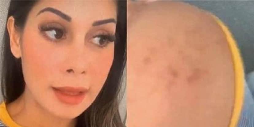 Mayra Cardi diz estar com o corpo todo empolado (Foto: Montagem) Mayra Cardi diz estar com o corpo todo empolado (Foto: Montagem)