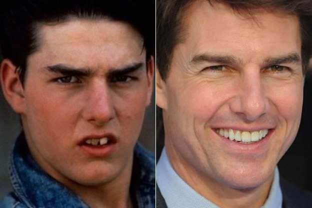 Famosos antes e depois da fama: Tom cruise (Foto: Reprodução) Famosos antes e depois da fama: Tom cruise (Foto: Reprodução)