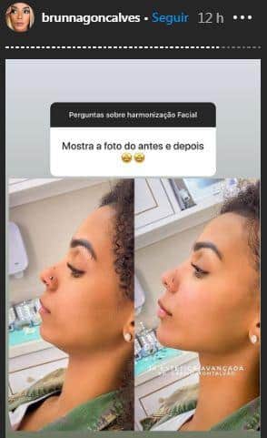 Esposa de Ludmilla, a bailarina Brunna Gonçalves contou que fez harmonização facial (Foto: Reprodução/ Instagram) Esposa de Ludmilla, a bailarina Brunna Gonçalves contou que fez harmonização facial (Foto: Reprodução/ Instagram)