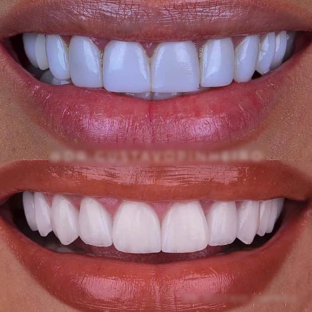 O antes e depois dos dentes de Simaria O antes e depois dos dentes de Simaria