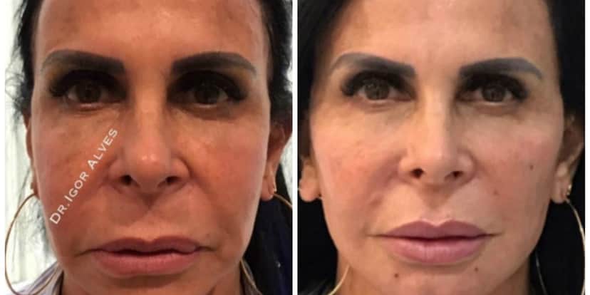 Gretchen antes e depois do processo (Foto: Reprodução) Gretchen antes e depois do processo (Foto: Reprodução)