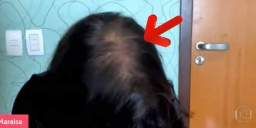 Maraisa, da dupla com Maiara revela ter doença sem cura nas redes sociais e mostra mudança após perda de cabelos no É De Casa - Foto: Reprodução/Globo Maraisa, da dupla com Maiara revela ter doença sem cura nas redes sociais e mostra mudança após perda de cabelos no É De Casa - Foto: Reprodução/Globo