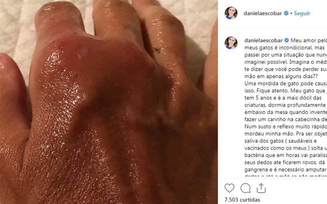Daniela Escobar mostra como sua mão ficou após mordida (Reprodução) Daniela Escobar mostra como sua mão ficou após mordida (Reprodução)