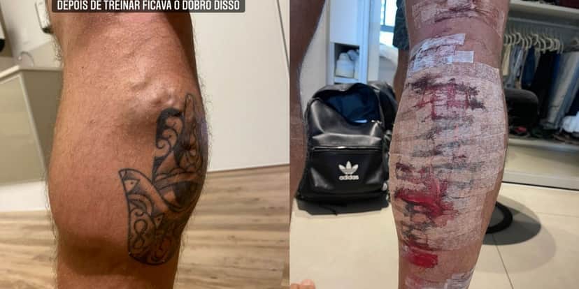 Jonas Sulzbach mostra antes e depois da cirurgia para retirada de varizes - Foto: Reprodução/Instagram Jonas Sulzbach mostra antes e depois da cirurgia para retirada de varizes - Foto: Reprodução/Instagram