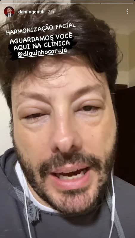 Danilo Gentili ficou com o rosto deformado (Foto: Reprodução/ Instagram) Danilo Gentili ficou com o rosto deformado (Foto: Reprodução/ Instagram)