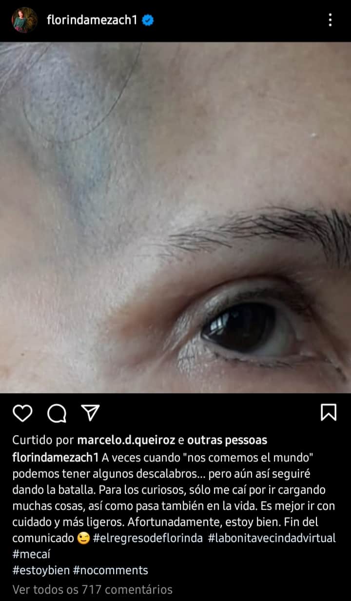 Atriz Florinda Meza, sofre acidente e posta foto nas redes sociais (Foto: Reprodução) Atriz Florinda Meza, sofre acidente e posta foto nas redes sociais (Foto: Reprodução)