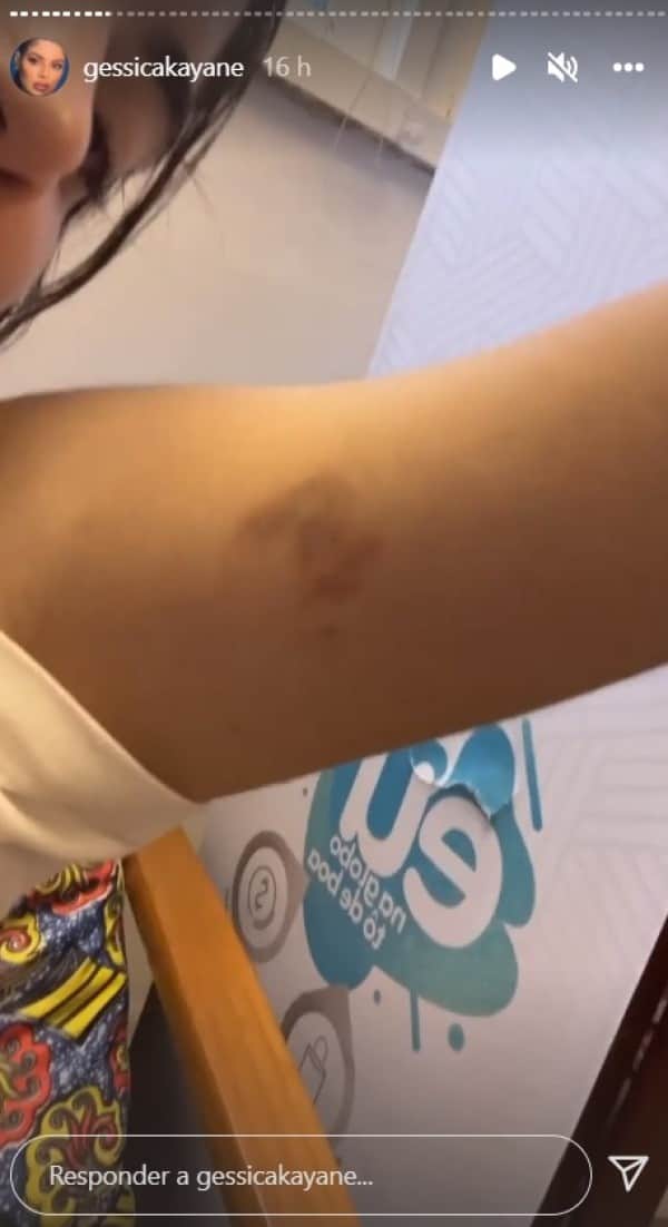 Publicação de Gkay onde ela aparece exibindo os hematomas (Imagem: Reprodução) Publicação de Gkay onde ela aparece exibindo os hematomas (Imagem: Reprodução)